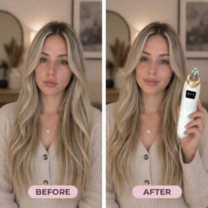 Blackhead Vacuum Pro